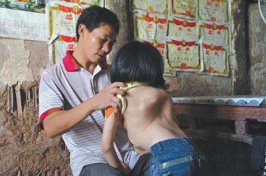 有嚴(yán)重脊椎畸形及胸腔隆突病的李文霞。