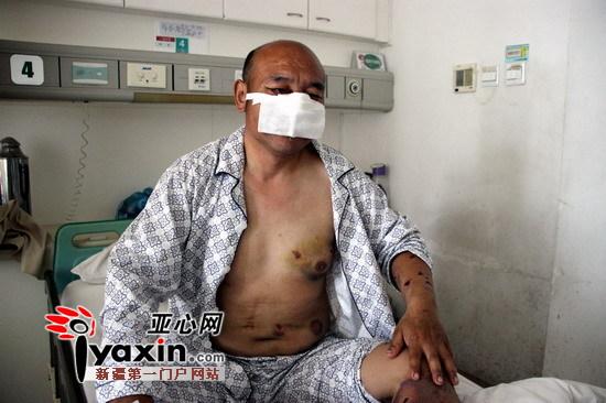 新疆沙灣村民山中撿玉遭棕熊攻擊 鼻子、上嘴唇被咬掉撿回一命（圖）