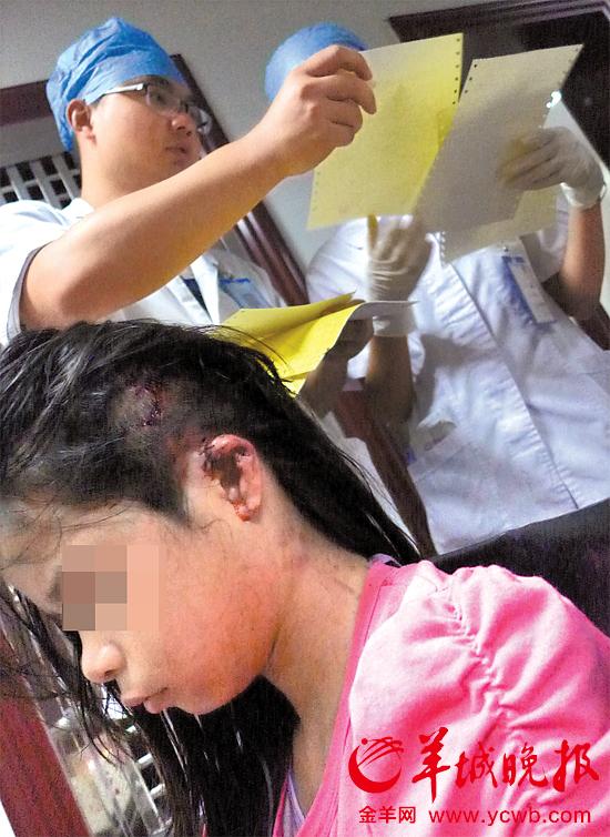 受傷的11歲女孩頭發(fā)被卷入扶梯，耳朵被嚴重拉傷，需手術(shù)。