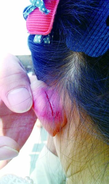 　　女童的耳朵被老師揪裂。圖片由女童家人提供