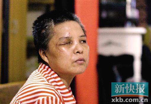 4月初,趙女士遭人搶劫并被打傷,現(xiàn)今右眼失明,頭部被縫100多針。記者 畢志毅/攝