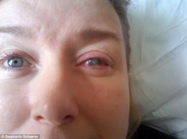 恐怖慎入！隱形眼鏡致英女子摘除眼球
