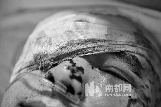 李建新頭部還有被潑硫酸的痕跡，醫(yī)生說被砍傷的右眼已經(jīng)失明。 南都記者 田飛 攝