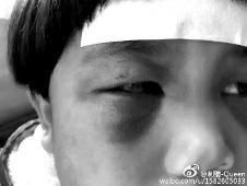 6月2日，網(wǎng)曝渭南市臨渭區(qū)一不滿5歲的女童遭奶奶毆打，眼圈青腫，引起網(wǎng)友關(guān)注，但孩子父母和爺爺均稱是摔倒導(dǎo)致。相關(guān)部門介入調(diào)查發(fā)現(xiàn)確為奶奶毆打所致，鑒于其身體原因已進(jìn)行批評(píng)教育。