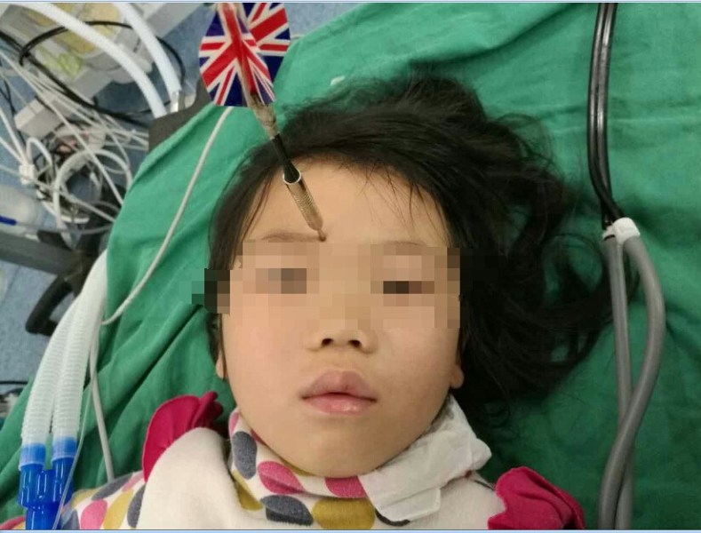十多公分長(zhǎng)的飛鏢穩(wěn)穩(wěn)地 ” 定 ” 在了一名六歲半的女童額頭上，小青一家人凌晨從長(zhǎng)順趕到貴醫(yī)附院急診室時(shí)，看到如此慘烈的情況，接診醫(yī)生都嚇了一跳。詳細(xì)詢問(wèn)下得知，原來(lái)是七歲的哥哥和六歲半的表妹在玩耍時(shí)，哥哥不慎將路邊撿來(lái)的真飛鏢扎到了妹妹的額頭上。