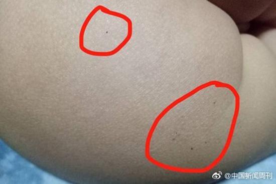 據(jù)多名紅黃藍(lán)(新天地分園)家長(zhǎng)反映，孩子腿部、屁股、腋下出現(xiàn)針眼。