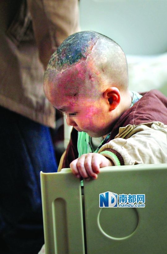 1月8日下午，小寶頭上和臉上都是傷痕。