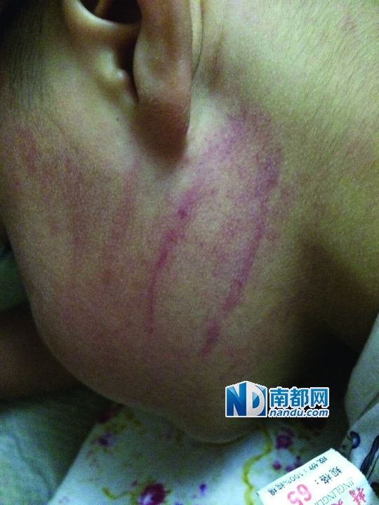 小逸臉上淤痕清晰可見。