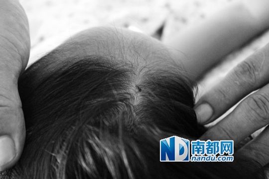 女童頭上被扎的針孔（圓圈處）。賈先生說，被扎不到三秒鐘，女兒就昏了。