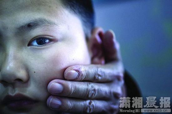 1月13日，小玨的父親心疼地摸著兒子的臉。