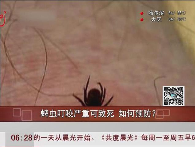 蜱蟲叮咬嚴重可致死如何預防？