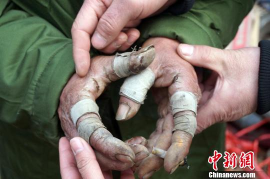 圖為由于常年拾荒，老人雙手布滿傷口。周小云 攝